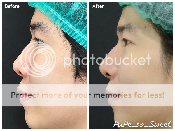  photo PP Before After Side.png